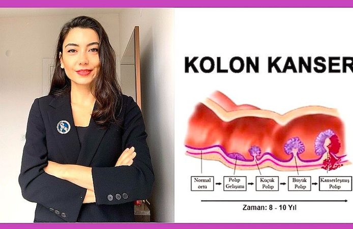 50 Yaştan Sonra Kolon Kanseri Riski Artıyor